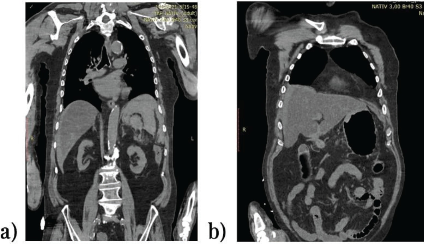 Hemoperitoneum caused by bleeding of adenomyosis: a case report